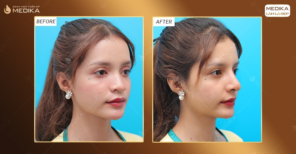 Hình ảnh trước và sau khi nâng mũi sụn sườn