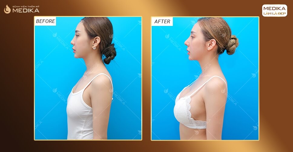 Hình ảnh trước sau nâng ngực ở Medika nhìn ngang từ bên trái