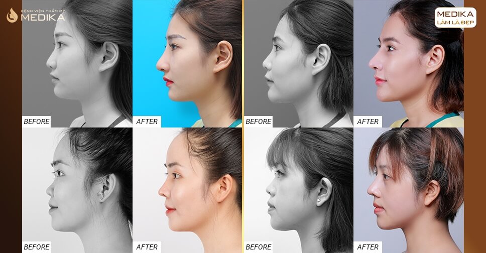 Hình ảnh trước và sau khi nâng mũi với 4 ca thẩm mỹ tại MEDIKA