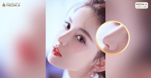 Nâng mũi bao lâu thì đầu mũi hết to?