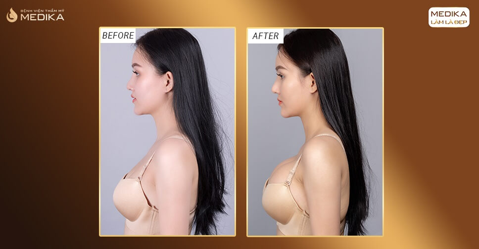 Trước và sau khi nâng ngực ở Medika có dùng phương pháp Massage