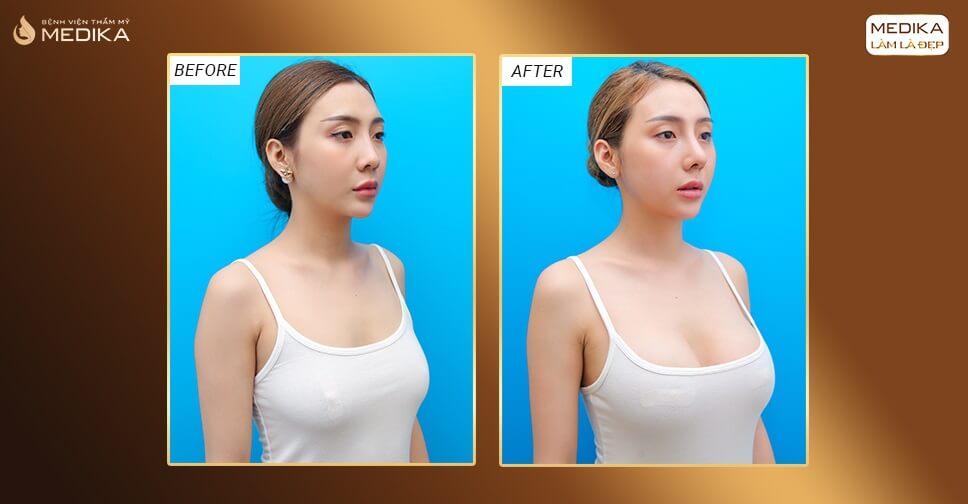 Trước và sau khi nâng ngực an toàn ở Medika