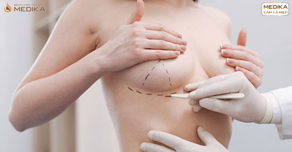 Túi ngực Polytech - Dòng túi phẫu thuật nâng ngực hỏng an toàn - MEDIKA.vn