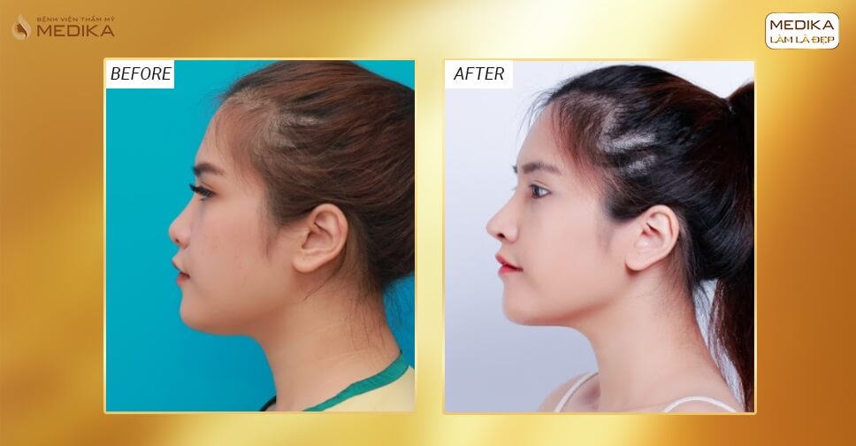 Hình ảnh trước và sau khi nâng mũi Surgiform hạn chế bong