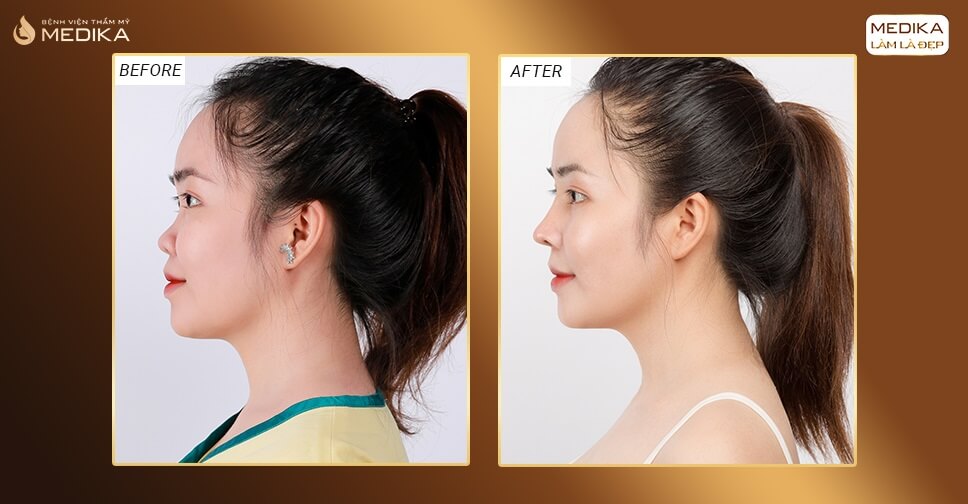 Hình ảnh trước và sau khi nâng mũi Surgiform