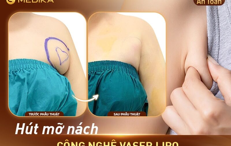 Hút mỡ nách