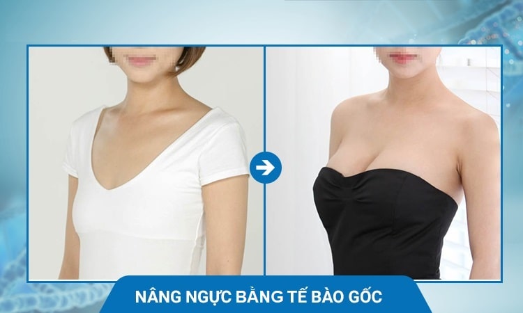 Nâng ngực bằng tế bào gốc