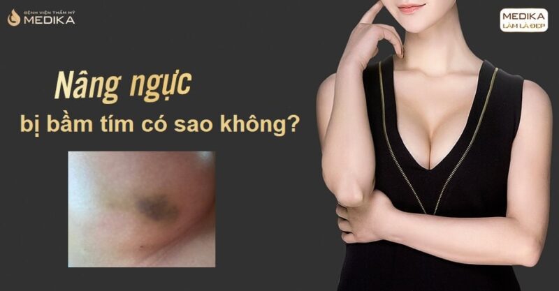 Nâng ngực bị bầm tím có sao không?