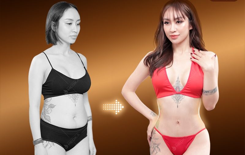 Tạo hình thành bụng công nghệ Plasma