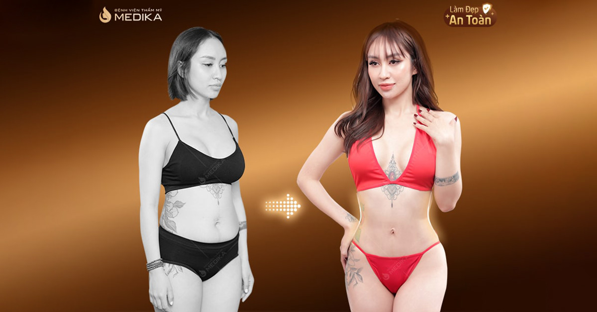 tao-hinh-bung-tai-bvtm-medika-co-hieu-qua-khong