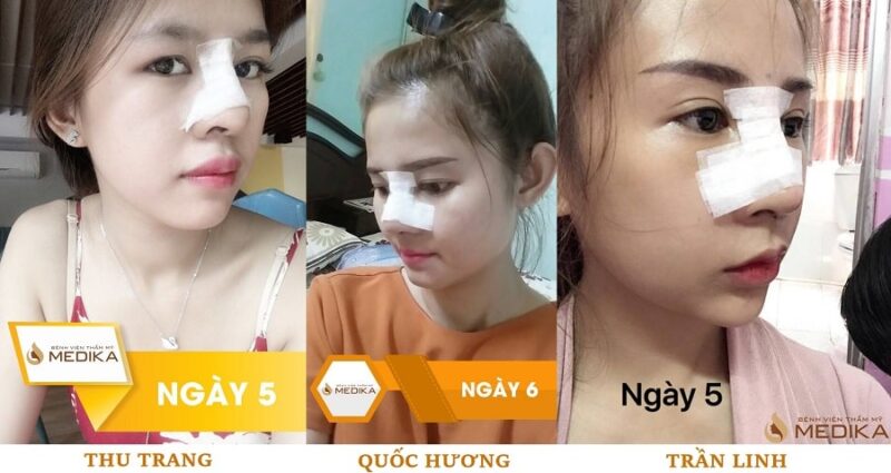 Hình ảnh nâng mũi sau 5 ngày của 3 vị khách của MEDIKA là Thu Trang, Quốc Hương và Trần Linh